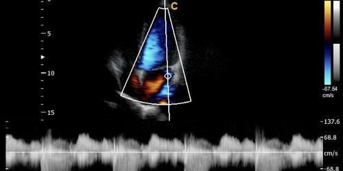 Advanced Cardiac Ultrasound Chison Q9 Color Doppler with Phased Array Probe