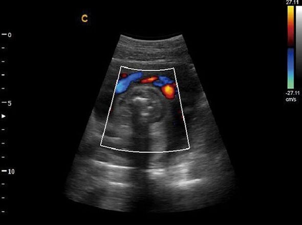 Advanced Cardiac Ultrasound Chison Q9 Color Doppler with Phased Array Probe